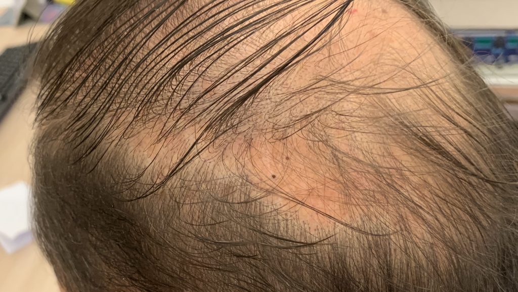 alopecia fibrosante frontale dermatologo verona