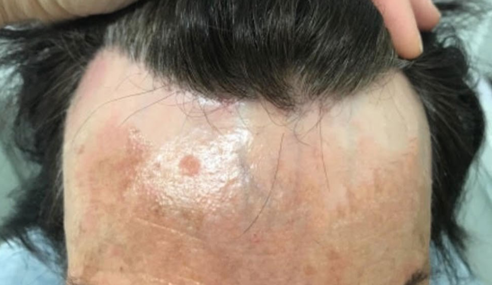 alopecia fibrosante frontale dermatologo