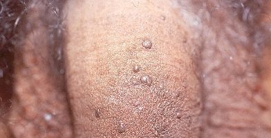 Papilloma virus uomo quali esame. Cancer hpv gorge